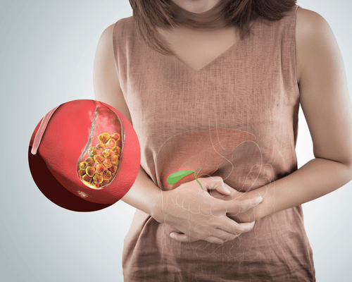 Gallbladder Stone & Gallbladder Stones