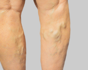 Varicose Veins treatment