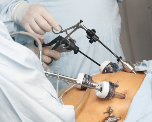 laparoscopy surgery