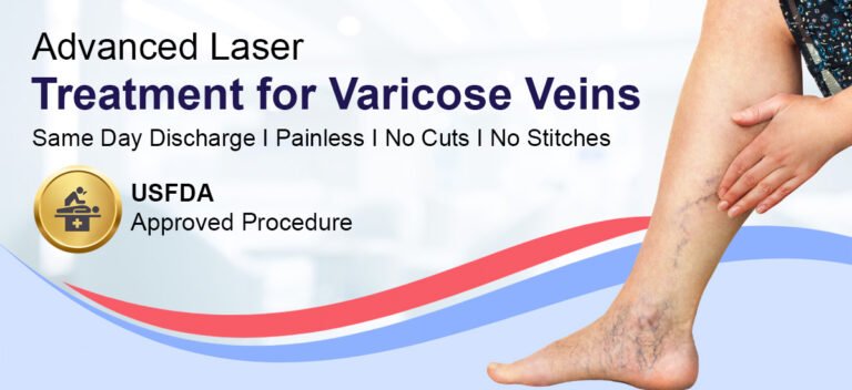 Varicose veins treatment