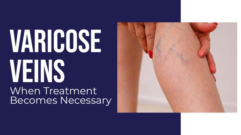When Treatment Becomes Necessary for Varicose Veins: Important Signs