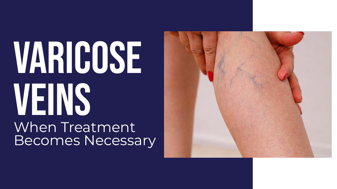 When Treatment Becomes Necessary for Varicose Veins: Important Signs