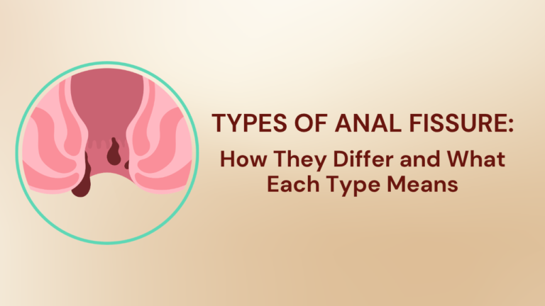 Types of Anal Fissure: How They Differ and What Each Type Means